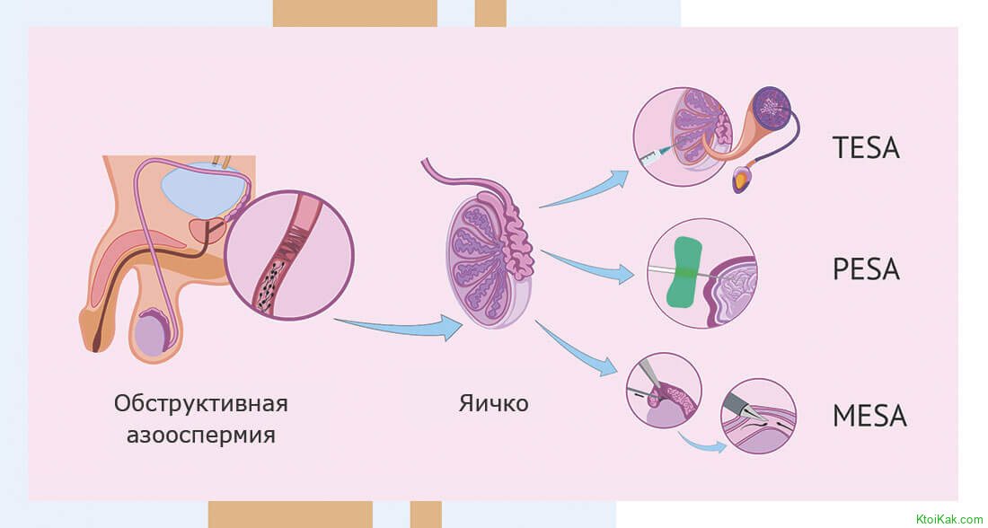 Синхронный цикл ЭКО и micro-TESE